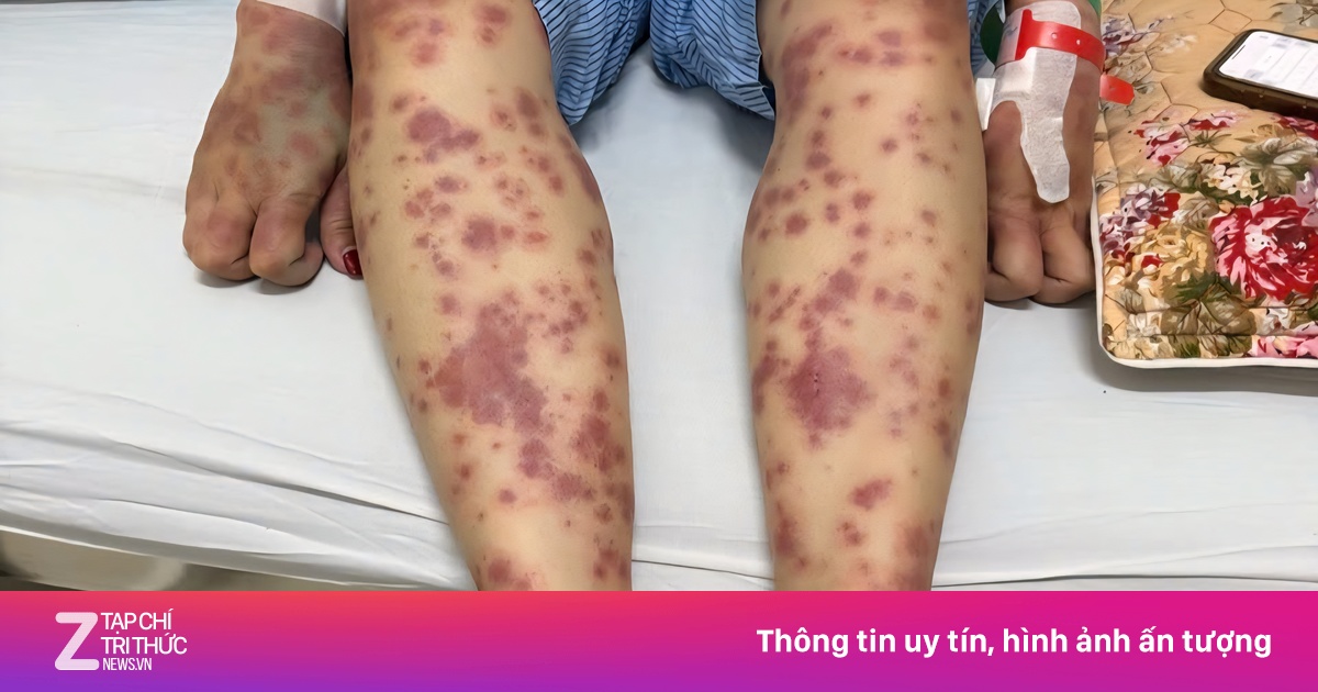 Nữ bệnh nhân nguy kịch vì thuốc giảm cân không rõ nguồn gốc