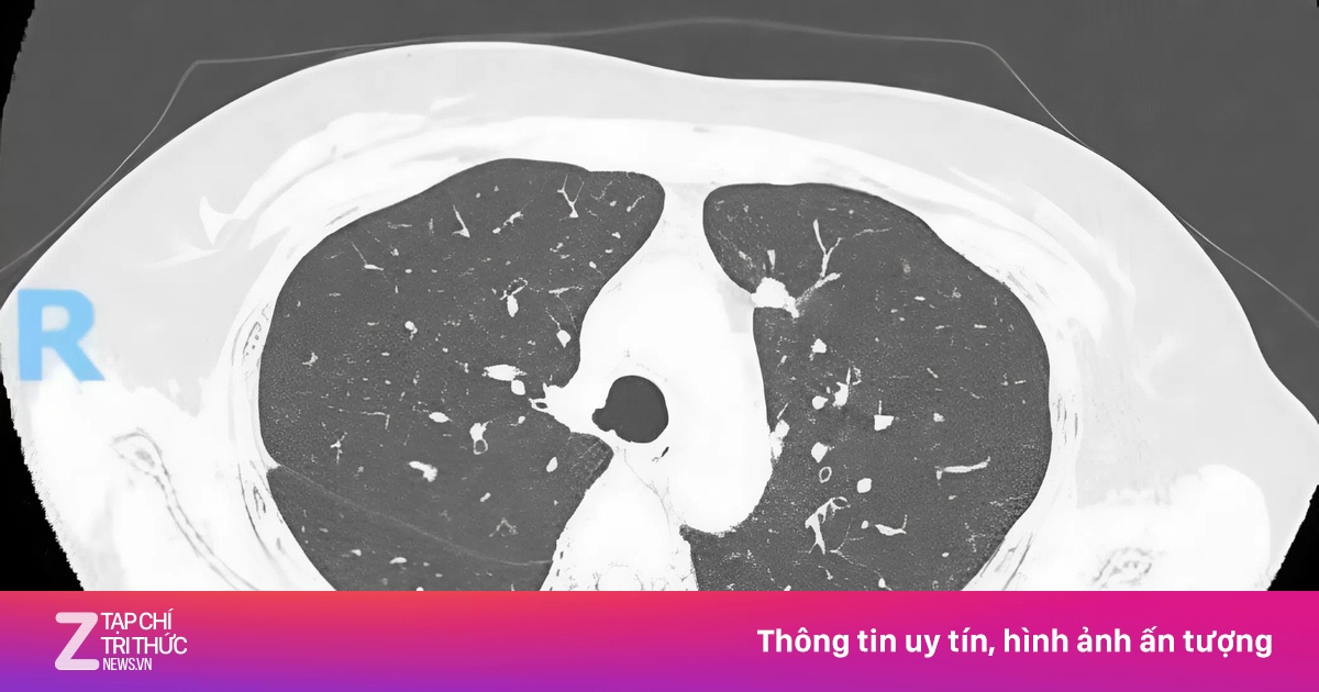 Từ nốt mờ nhỏ ở phổi, hai bệnh nhân ở TP.HCM phát hiện ung thư