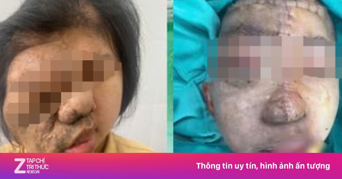 Cô gái 19 tuổi mang khối u khắp đầu mặt cổ được phẫu thuật