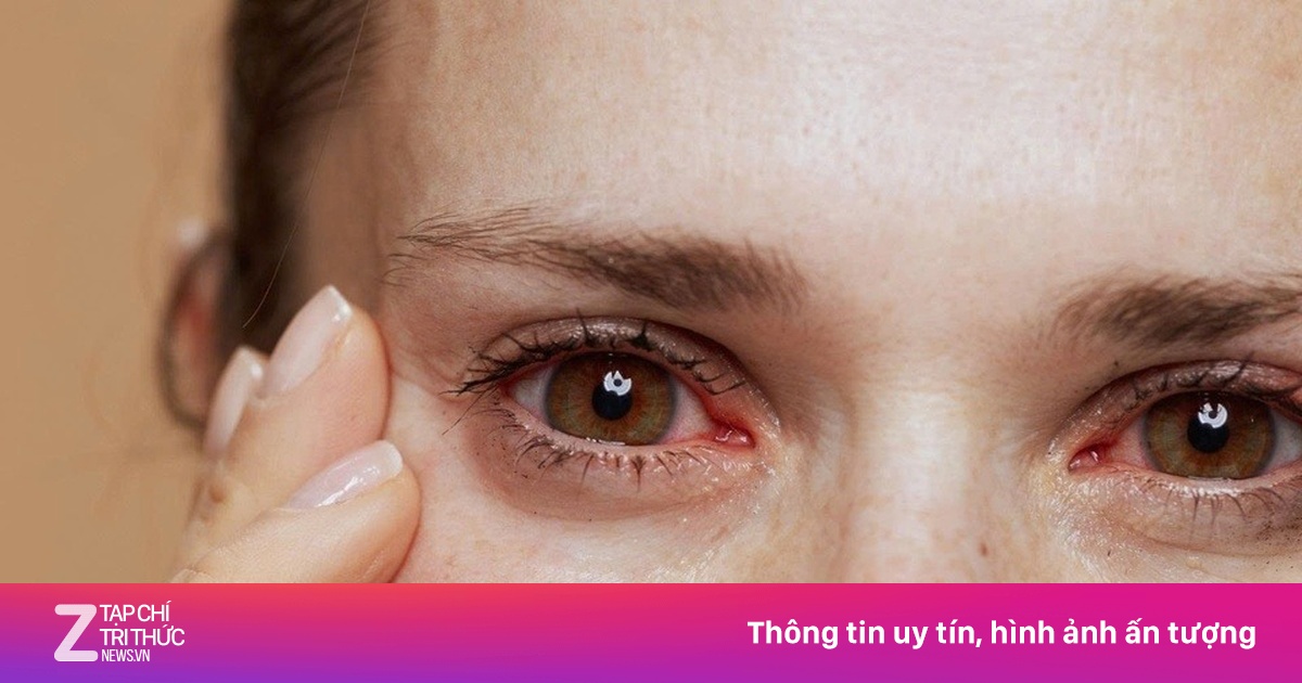 Dấu hiệu gan yếu biểu hiện ở mắt