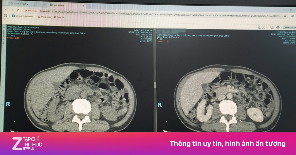 Thói quen sau bữa ăn khiến người đàn ông có cả ổ mủ trong gan
