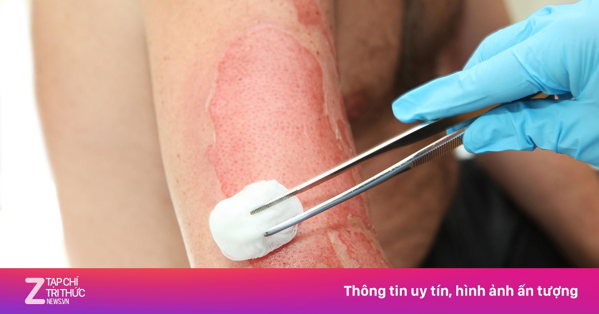 Bác sĩ TP.HCM cứu bé gái bị bỏng thương tâm 70% cơ thể