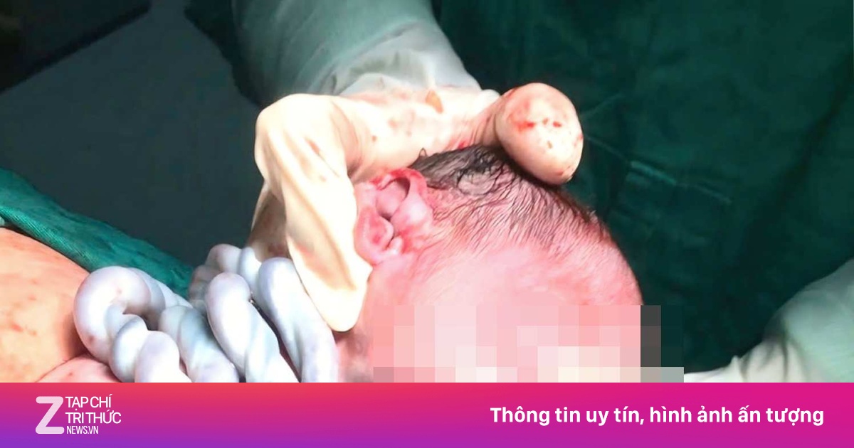 Thai nhi bị dây rốn quấn cổ 5 vòng