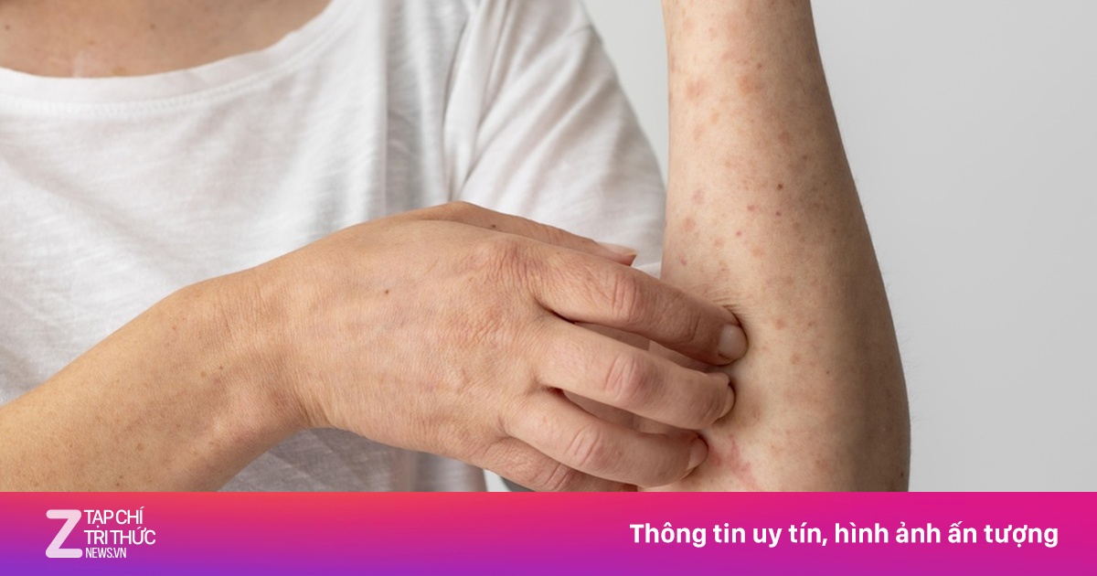 Dấu hiệu cần xét nghiệm ký sinh trùng: Chuyên gia chỉ rõ triệu chứng và nhóm nguy cơ cao