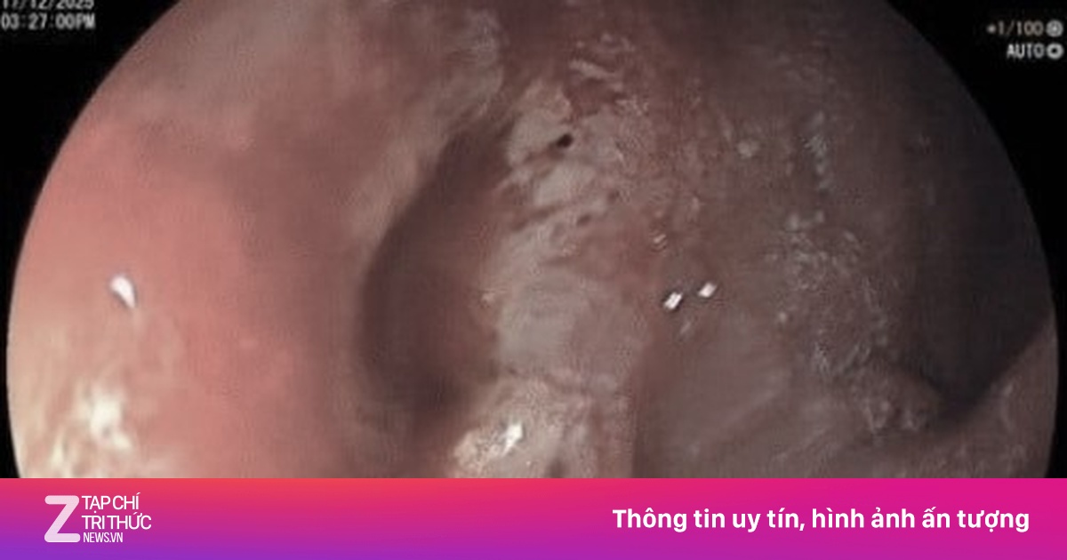 Một thói quen 'tự hủy' dạ dày rất nhiều người trẻ mắc