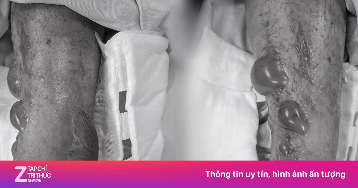 Sai lầm khi chữa đau chân khiến người đàn ông chịu hậu quả