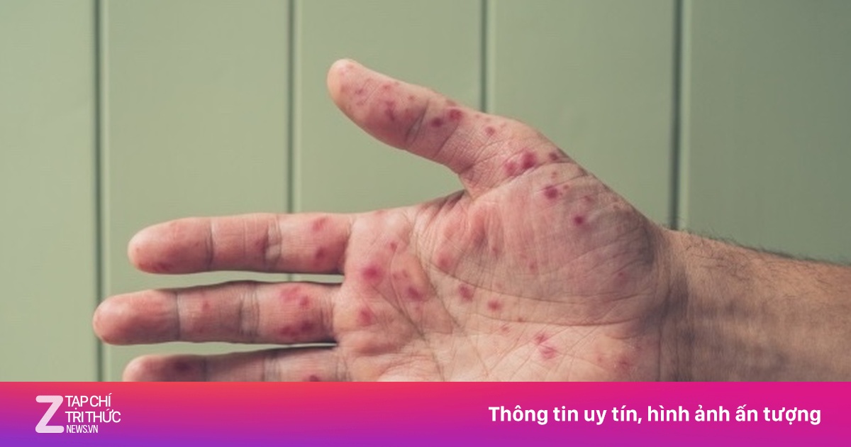 Một bệnh tăng sốc, TP.HCM cảnh báo ‘sóng dịch’