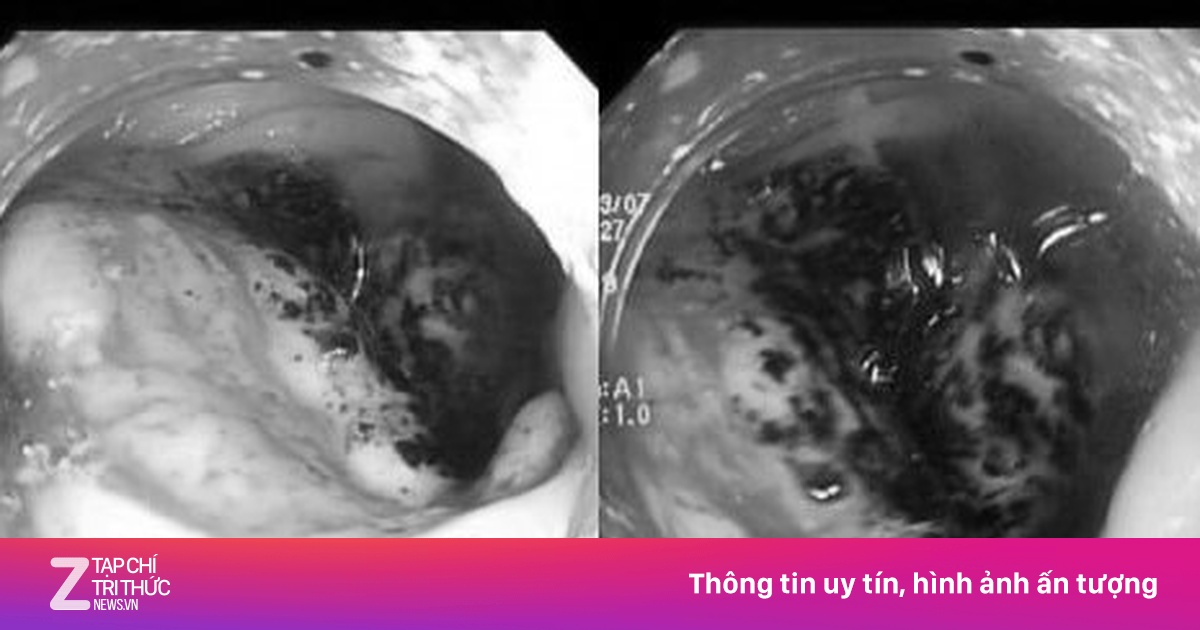 Yếu tố 'nuôi dưỡng' ung thư đại trực tràng nhiều người trẻ không hay