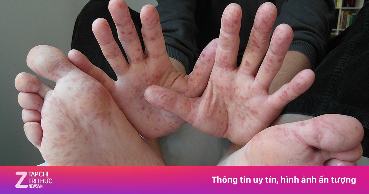Tay chân miệng vào cao điểm: EV71 gây bệnh nặng, khi nào cần nhập viện?
