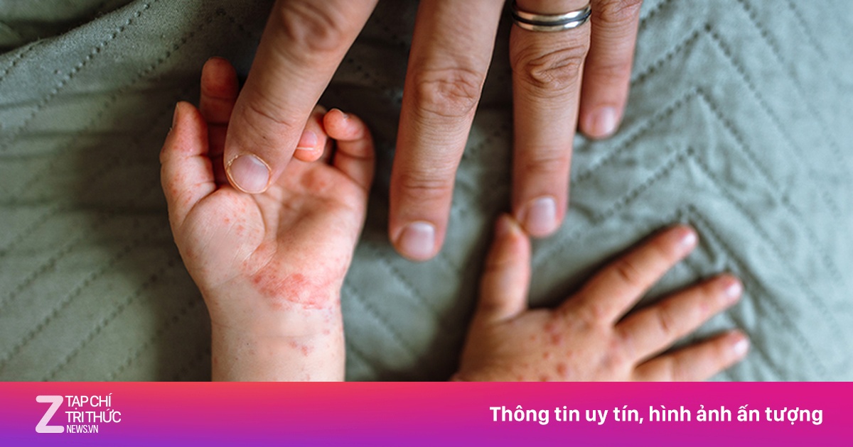 Giai đoạn khởi phát của bệnh tay chân miệng có biểu hiện gì?