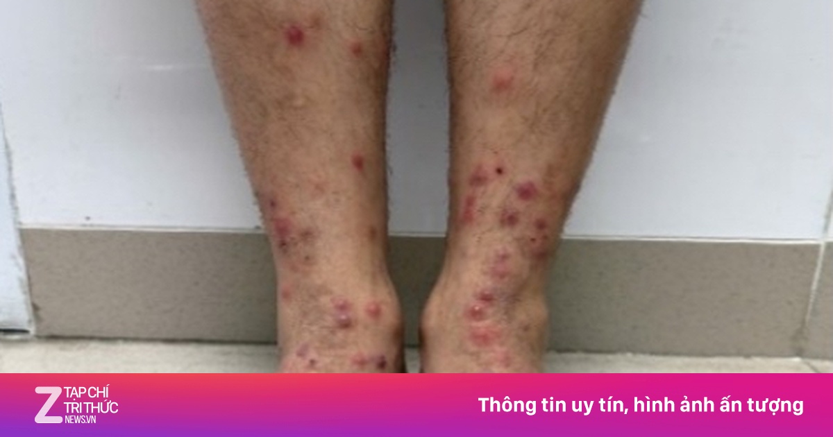 Cảnh báo từ chuyên gia: Tự ý tắm lá khi ngứa do bọ chét khiến bệnh trầm trọng hơn
