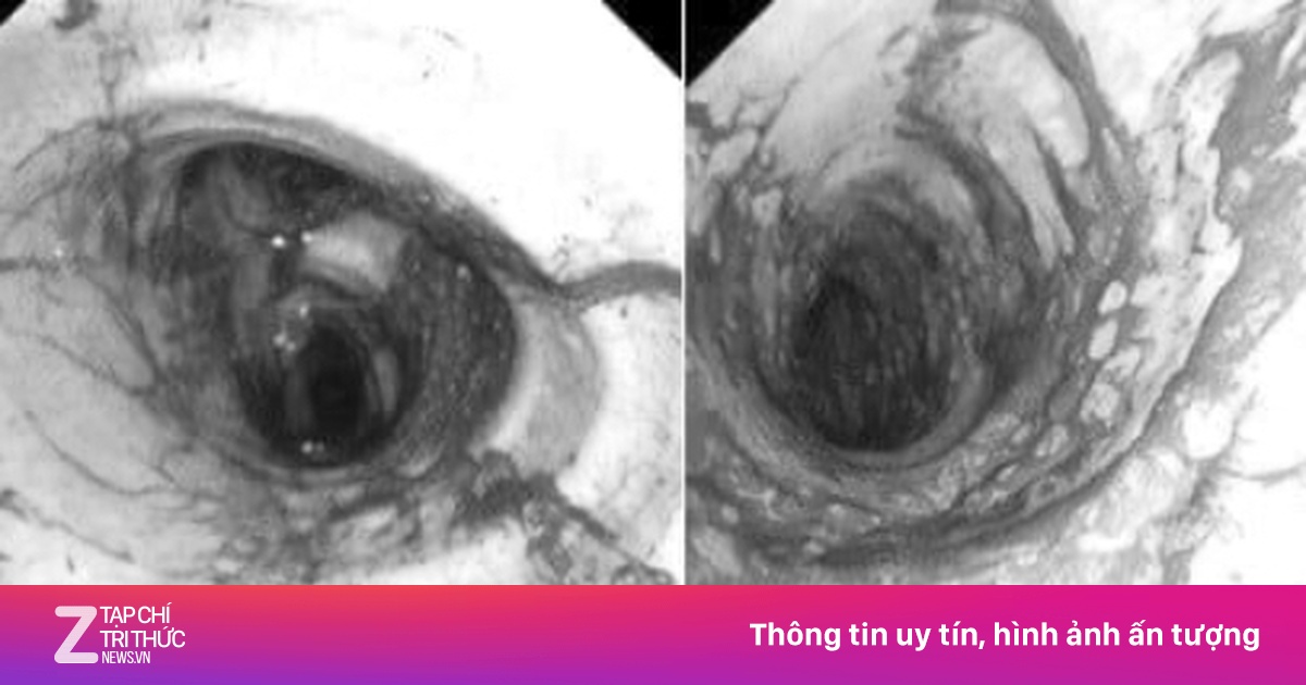 Đường thở đầy muội than của 2 người sống sót sau vụ cháy ở TP.HCM