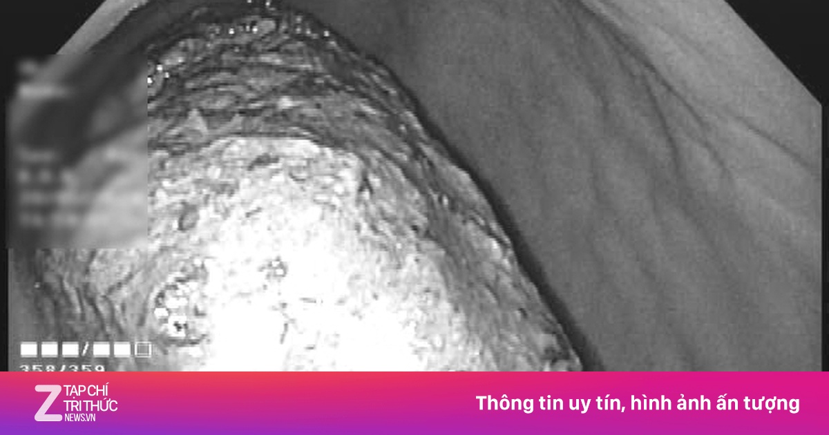 Bác sĩ kinh ngạc phát hiện dị vật 'khủng' trong dạ dày bệnh nhân