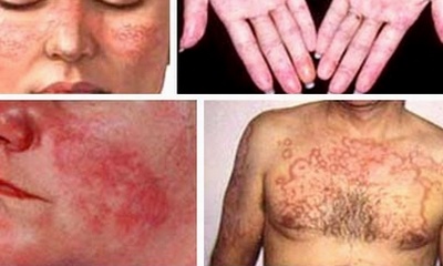 Một số tổn thương cơ thể do Lupus ban đỏ. Ảnh: SKĐS