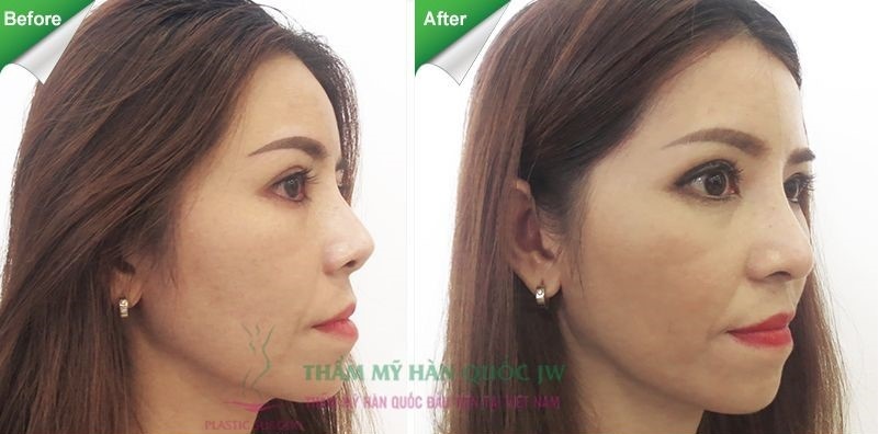 Bệnh nhân đã phẫu thuật nâng mũi nhiều lần nhưng mũi bị lộ sống, đầu mũi nhọn và ngắn. Sau 3 tháng nâng mũi S line với bác sĩ Tú Dung tại Thẩm mỹ viện Hàn Quốc JW, mũi không còn lộ sống mà có độ lướt mềm mại, đầu mũi tròn và dài kín.