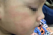 Đuổi việc cô giáo tát trẻ 3 tuổi bầm tím mặt, tụ máu môi