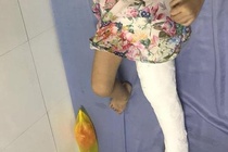 Giao vien to hieu truong gian doi trong vu chau be bi gay xuong dui hinh anh