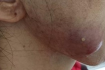 Những biến chứng do xóa nếp nhăn gây ra