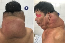 Phau thuat thanh cong khoi u gan 5 kg cho 'nguoi gau' hinh anh
