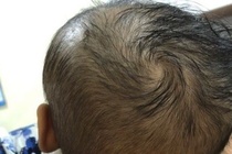 Bé 6 tháng tuổi bị tụ máu não vì ngã khi tập đi
