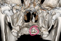 Răng mọc ngầm chọc thủng hốc mũi