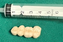 Đỡ cháu bị ngã, người phụ nữ nuốt 4 chiếc răng giả