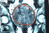 Chu quan voi benh, nguoi dan ong ganh hau qua sau nhieu nam hinh anh