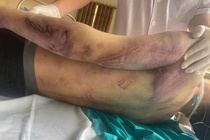 Bo Y te chi dao 'nong' sau vu hoc vien Trung tam CTXH Hai Ha tu vong hinh anh