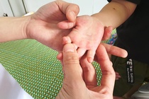 Bệnh nhân mắc tay chân miệng ở Quảng Nam tăng đột biến