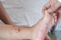Cháu bé tử vong do bệnh tay chân miệng ở Đắk Lắk