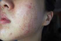 Da mặt bị hủy hoại vì ô nhiễm không khí