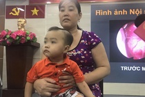 Bé trai bị lồi mắt do khối u hiếm gặp trong hốc mũi
