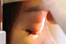 Tiem filler nang mui lam dep don Tet, benh nhan 15 tuoi mu mat hinh anh