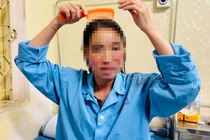 Tốn 11 triệu đồng cấy tóc, người phụ nữ mới phát hiện bị Lupus ban đỏ