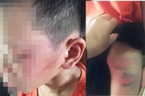 Be trai 12 tuoi to bi me ke bao hanh phai nhap vien hinh anh
