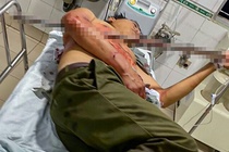 Tổ trưởng dân phòng bị thương khi ngăn chặn hỗn chiến