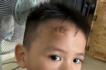 'Khoi nghi he' nga gay chan, sut dau khau 3 mui du moi nghi 2 tuan hinh anh