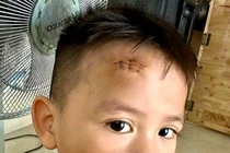'Khoi nghi he' nga gay chan, sut dau khau 3 mui khien bo me khoc thet hinh anh