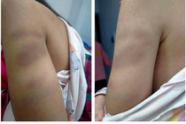 Cô giáo đánh tím tay học sinh lớp 1