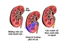 Tán sỏi ngoài cơ thể.