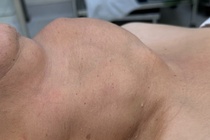 Nguoi phu nu mang khoi buou co khong lo suot 30 nam hinh anh