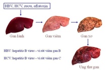 Những bệnh ung thư đến từ miệng