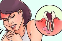 10 cach hieu qua giup ban 'chong choi' voi con dau khi moc rang khon hinh anh