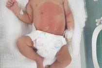 Bé sơ sinh bị bỏng da vì gia đình chữa chướng bụng bằng lá trầu