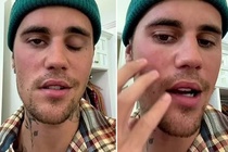 Justin Bieber mất 6 tháng để điều trị liệt cơ mặt