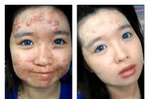 Thu thuat trang diem cua co nang mat day mun hinh anh