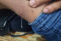 Nhung dau hieu khi nhiem giun rong hinh anh