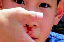 Chay mau cam o tre em: xu tri va phong ngua hinh anh