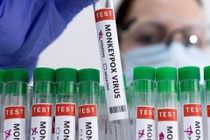 Đa số người mắc đậu mùa khỉ nghiêm trọng ở Mỹ đều nhiễm HIV