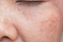 Biến đổi khí hậu đang làm tăng tỷ lệ nhiễm trùng da ở người